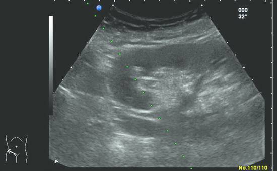 Percutaneous Renal Biopsy | Radiology Key