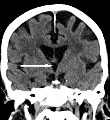 Neuroanatomy and Head & Neck Anatomy | Radiology Key