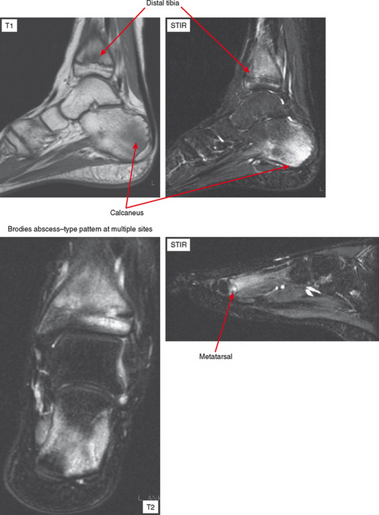 INFECTION OF THE MUSCULOSKELETAL SYSTEM | Radiology Key