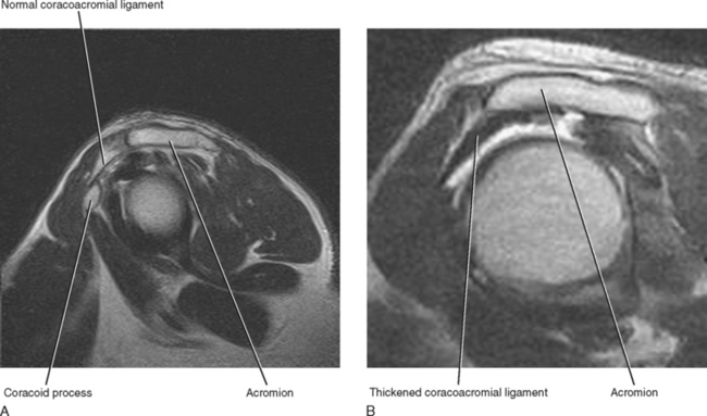 Typical magnetic resonance imaging scan showing the coracohumeral