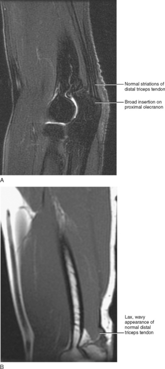 how to read mri images of elbow