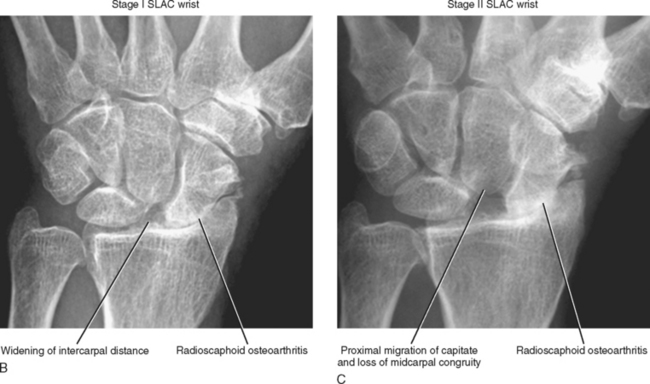 IMAGING OF THE WRIST | Radiology Key