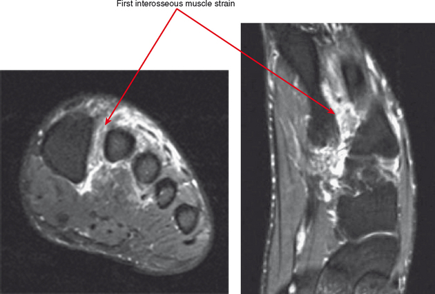 IMAGING OF THE FOREFOOT AND MIDFOOT | Radiology Key