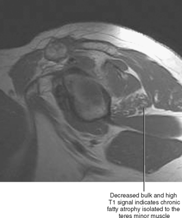 Muscle Injury  Radiology Key