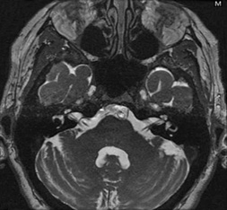 internal auditory canal mri anatomy