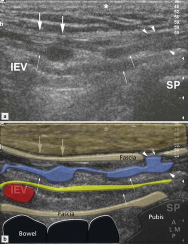 Osmosis from Elsevier - The inguinal canal lies between the muscles of the  anterior abdominal wall. The canal is bound superiorly by the internal  oblique and transversus abdominis muscles,anteriorly by the external