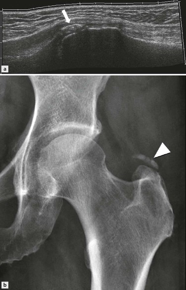 Disorders of the Groin and Hip: Lateral and Posterior | Radiology Key