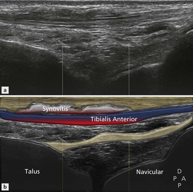 Disorders of the Ankle and Foot: Anterior | Radiology Key