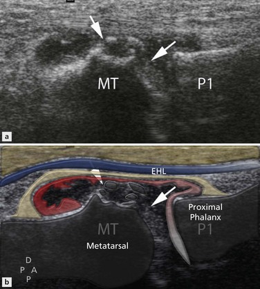 Disorders of the Ankle and Foot: Forefoot | Radiology Key