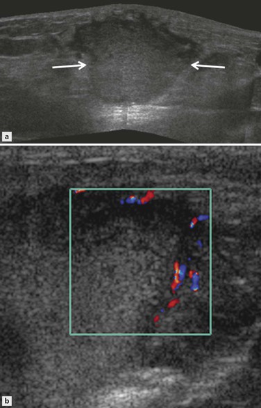 Ultrasound of Soft Tissue Masses | Radiology Key