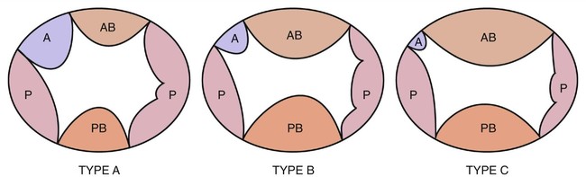 atrioventricular-septal-defects-radiology-key