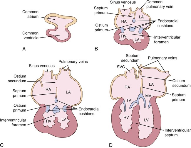 Atrioventricular Septal Defects | Radiology Key