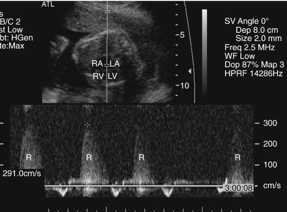 atrioventricular-septal-defects-radiology-key