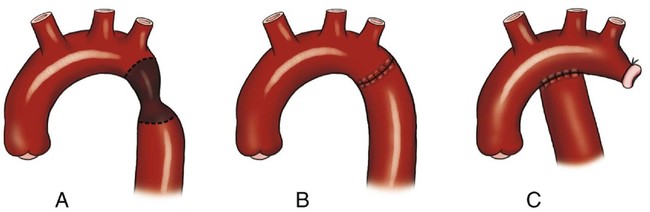 Coarctation of the Aorta | Radiology Key