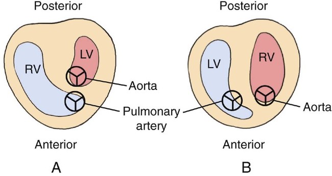 Complete and Congenitally Corrected Transposition of the Great Arteries ...