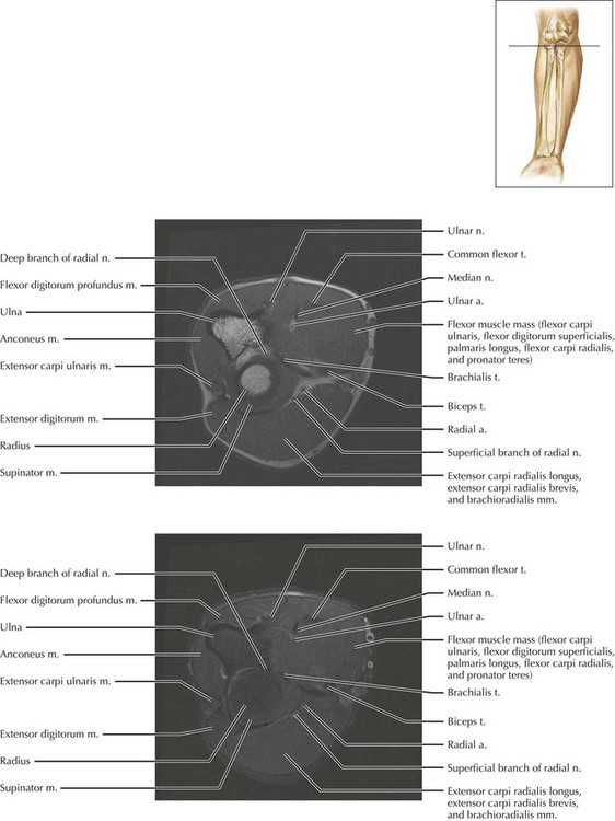 Inner Forearm Layout.pdf Forearm | Radiology Key