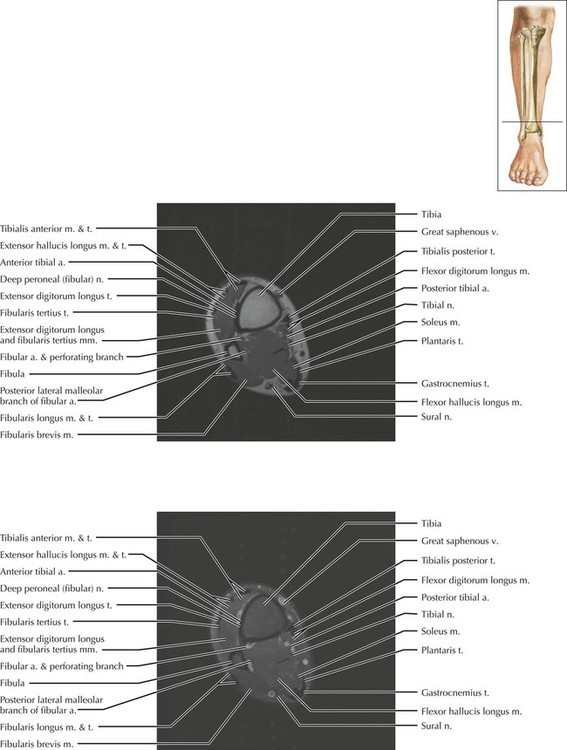 compartments of leg radiology