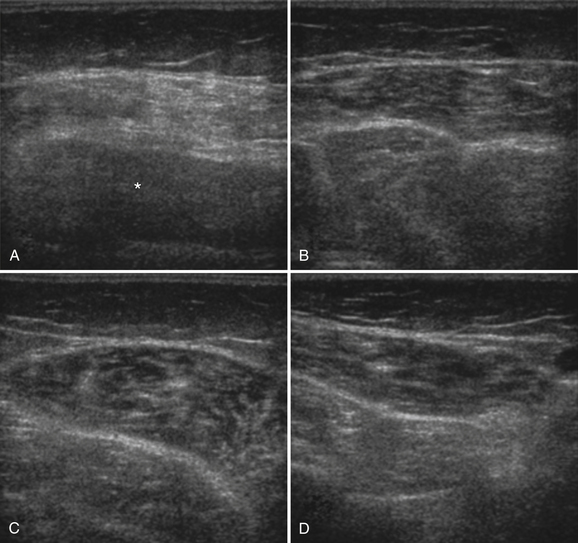 Ultrasound Of Muscular Dystrophies, Myopathies, And Muscle Pathology ...