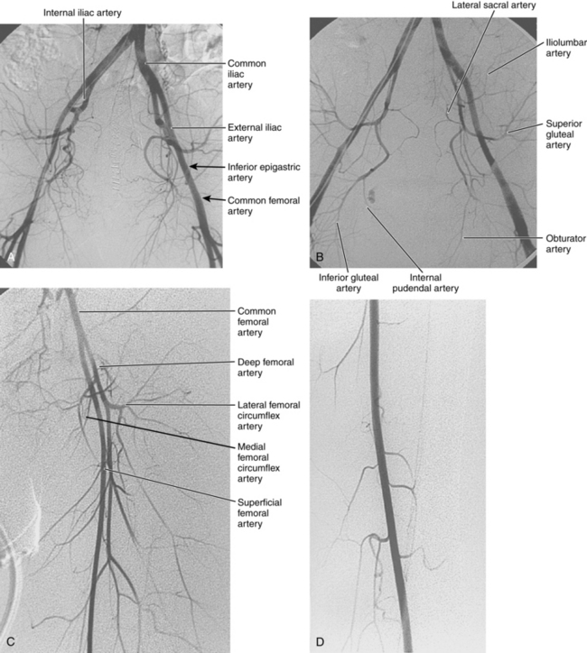 obturator artery angiogram