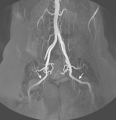 Pelvic and lower extremity arteries | Radiology Key