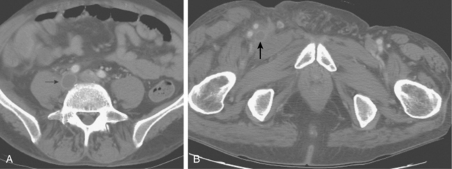 chronic dvt right arm icd 10