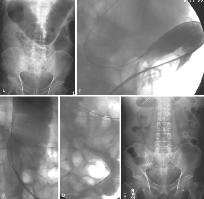 Gastrointestinal Interventions | Radiology Key