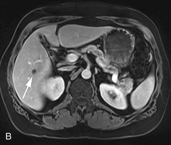 Pulsation, and Other Artifacts | Radiology Key