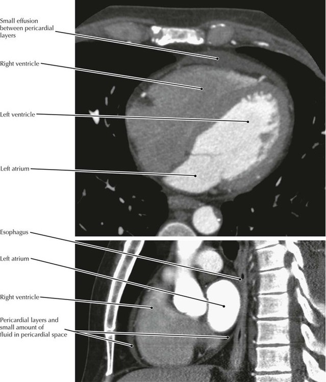 Thorax | Radiology Key