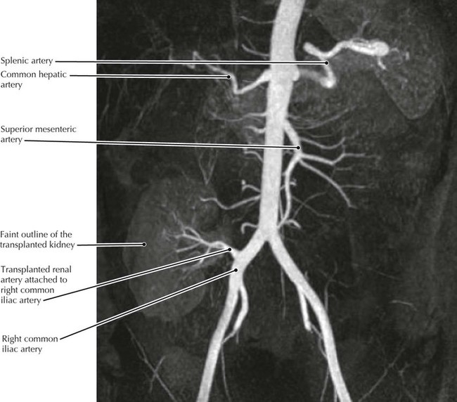 Abdominal Aorta Anatomy Ct
