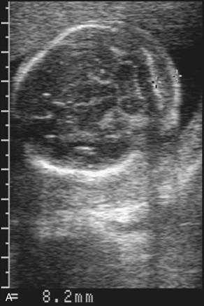 Prenatal Screening for Aneuploidy | NEJM