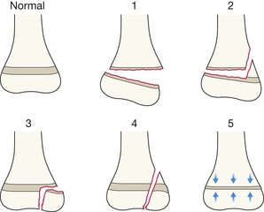 Particular paediatric points | Radiology Key