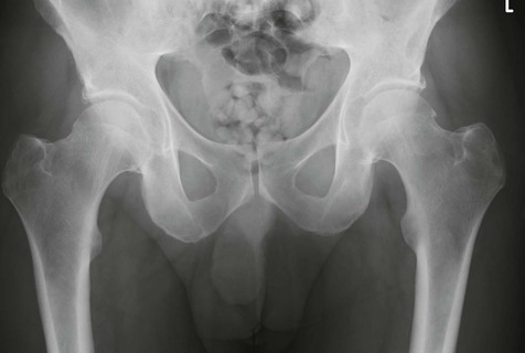 normal female adult right hip xray