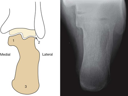 Does axial view still play an important role in dealing with calcaneal  fractures? | BMC Surgery | Full Text