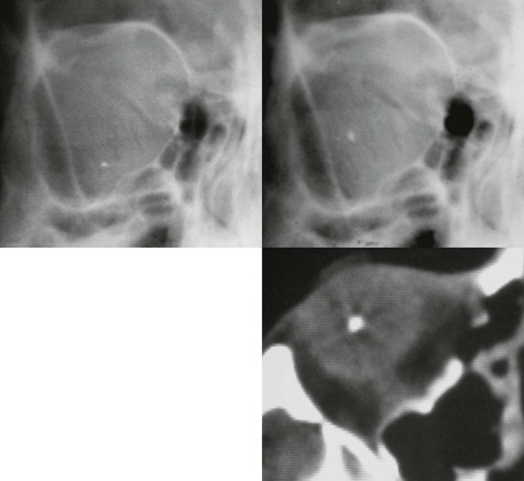 Penetrating foreign bodies | Radiology Key
