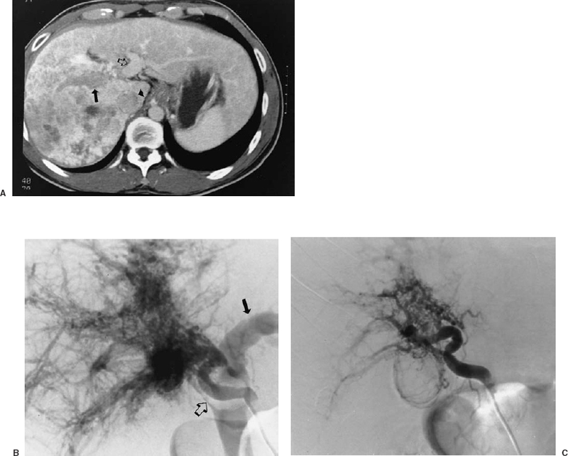 General Principles of Embolization and Chemoembolization Radiology Key