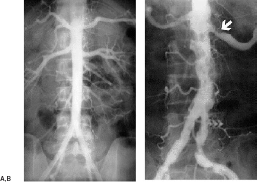 Atherosclerotic Aorta