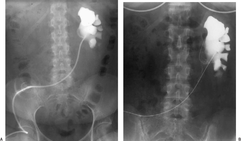 obstructive-uropathy-and-renal-calculus-disease-radiology-key