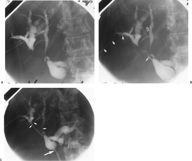 Dilated Biliary Tree