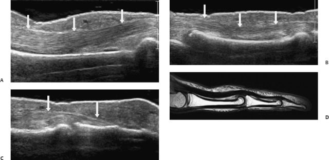 Imaging Of The Hand Radiology Key 5429