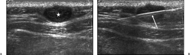 soft tissue,B-Ultrasound Model for Interventional Ultrasound 