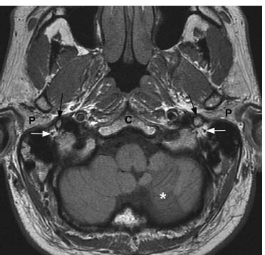 Facial Nerve Anatomy Mri Temporal Bone Imaging Anatomy Facial Nerve