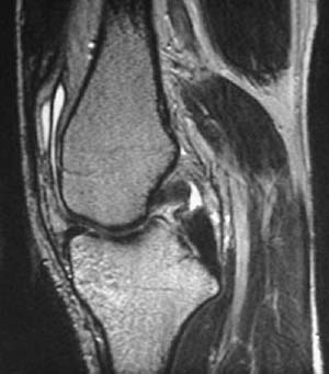 2 Posterior Cruciate Ligament Tear | Radiology Key