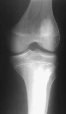 33 Fong's Disease/Nail Patella Syndrome | Radiology Key