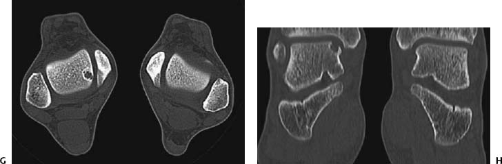osteochondritis dissecans ct necrovertebrális osteoarthritis és kezelése