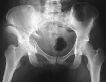 right acetabular fracture