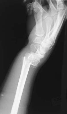 colles fracture pain