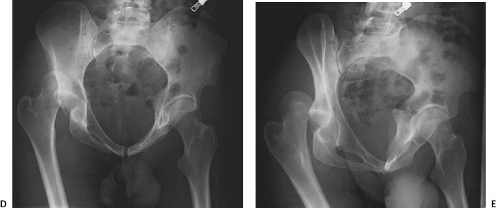 Bilateral central fracture-dislocation of hips after myelography