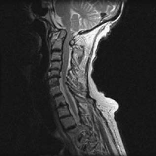 atlantoaxial instability radiology figure 103d