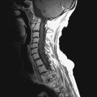 atlantoaxial instability radiology figure 103f