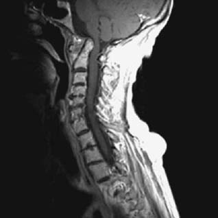 atlantoaxial instability figure 103g